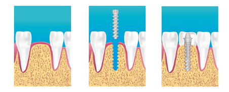implants dentaires marseille 13008